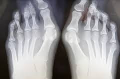 Best Foot Forward, Reduce Foot Pain from Bunions and Hammer Toes by creating space and increasing Range of Motion in Toes